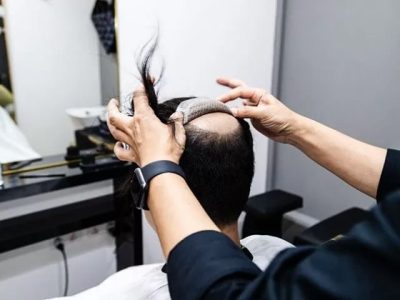 Hair pieces, a non-surgical non-invasive solution, are an alternative to hair transplantation.